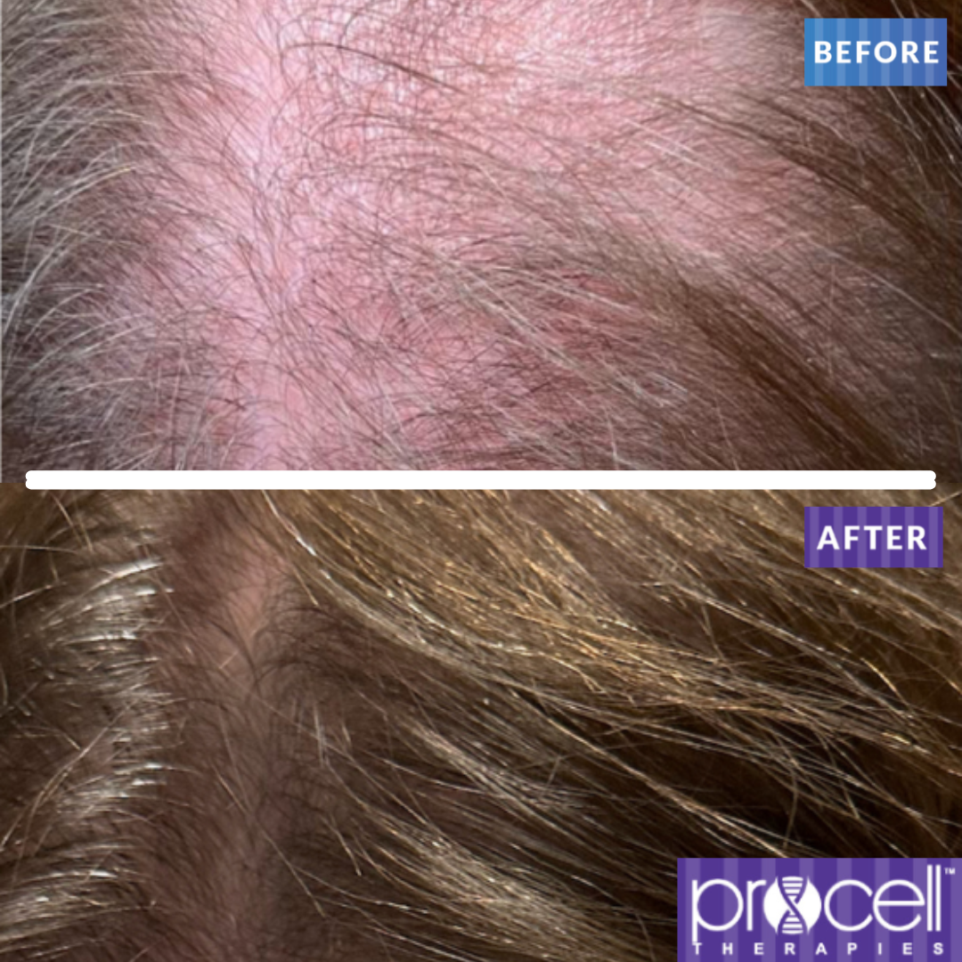 Procell® Hair Rejuvenation Therapy for Men & Women - Full Scalp - Maintenance Treatment