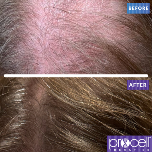 Procell® Hair Rejuvenation Therapy for Men & Women - Full Scalp - Maintenance Treatment
