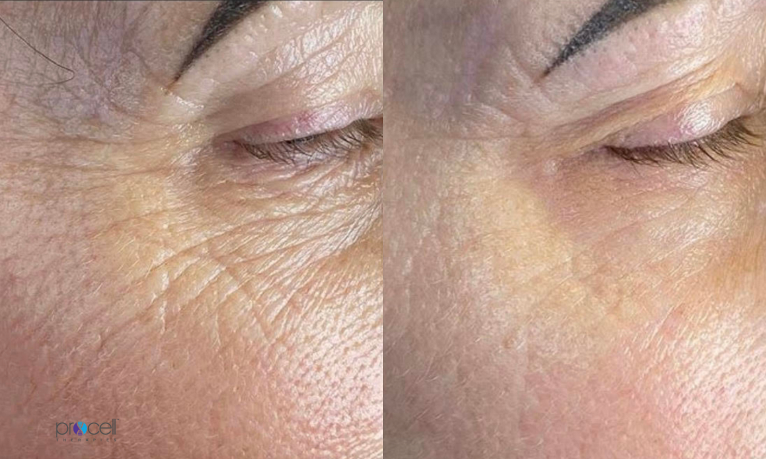 Procell Microchanneling results on eye area and crows feet at Eleanor Olsen Facial Clinic Grayshott Surrey
