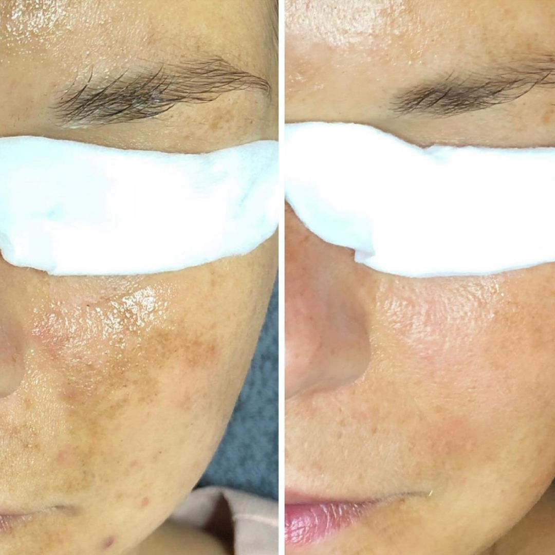 Esse Live Probiotic Experience facial results on cheeks at Eleanor Olsen Facial Clinic Grayshott Surrey